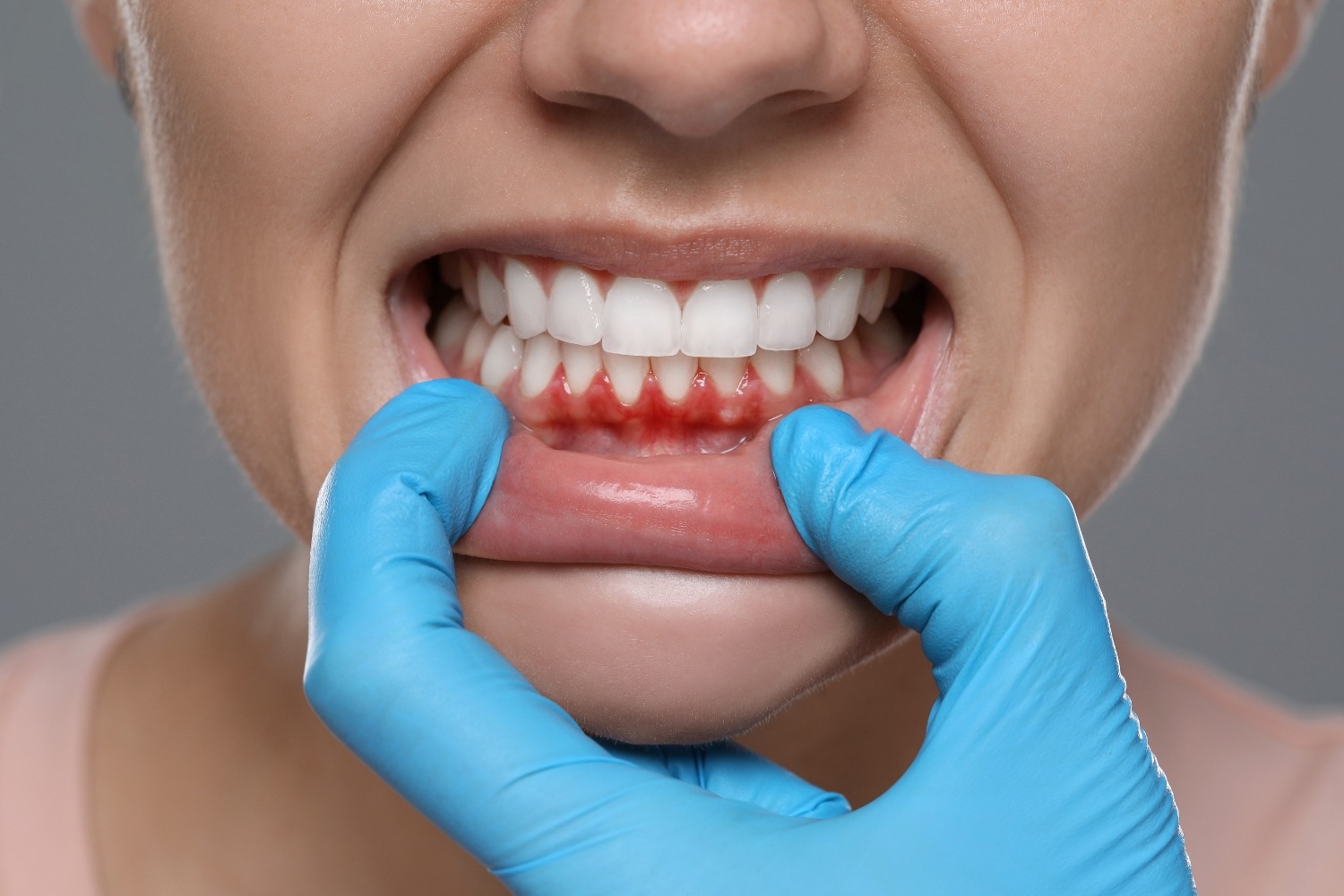 parodontite a riva del garda, come si cura la parodontite ai denti