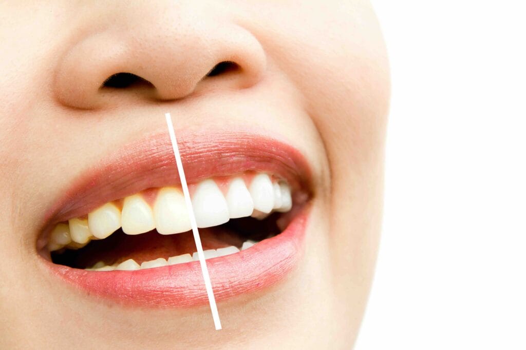 Cosa mangiare dopo sbiancamento denti
